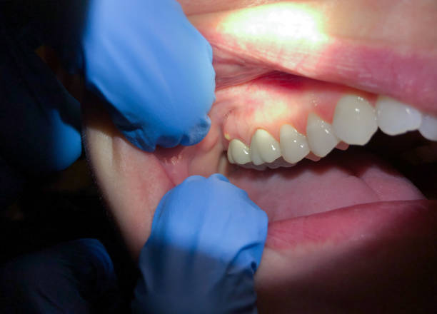 Best Emergency Tooth Extraction in Bell Nyon, CA