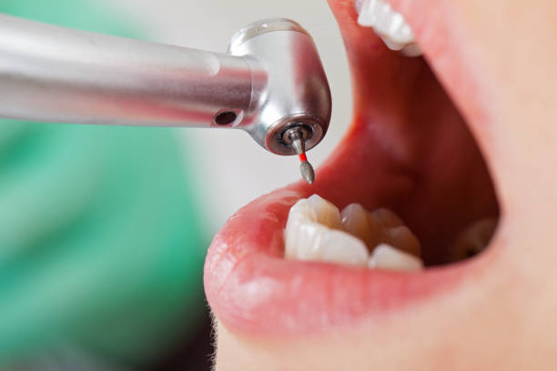 Best Emergency Wisdom Teeth Removal in Bell Nyon, CA